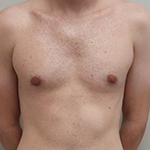 Gynecomastia Before and After Pictures Fort Lauderdale, FL