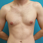 Gynecomastia Before and After Pictures Fort Lauderdale, FL