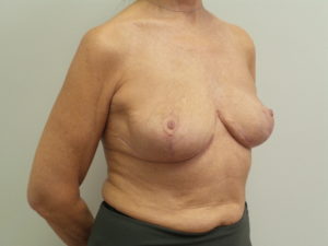 Breast Implant Revision/Replacement Before and After Pictures Fort Lauderdale, FL