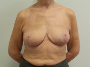 Breast Implant Revision/Replacement Before and After Pictures Fort Lauderdale, FL