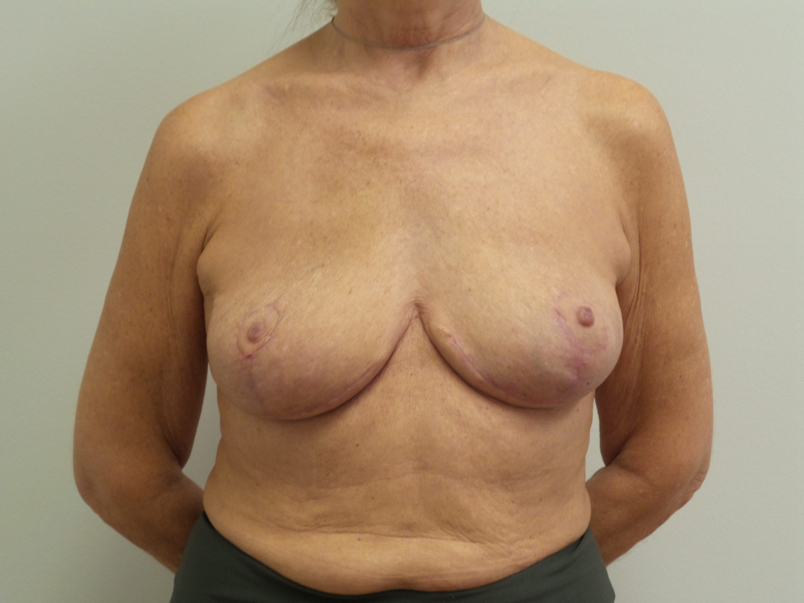 Breast Implant Revision/Replacement Before and After Pictures Fort Lauderdale, FL