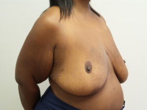 Breast Reduction Before and After Pictures Fort Lauderdale, FL