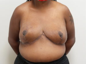 Breast Reduction Before and After Pictures Fort Lauderdale, FL