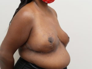 Breast Reduction Before and After Pictures Fort Lauderdale, FL