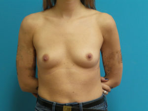 Breast Augmentation Before and After Pictures Fort Lauderdale, FL