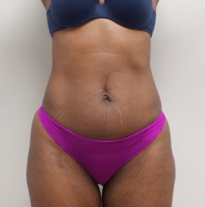 Mini Tummy Tuck Before and After Pictures Fort Lauderdale, FL