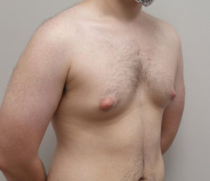 Gynecomastia Before and After Pictures Fort Lauderdale, FL