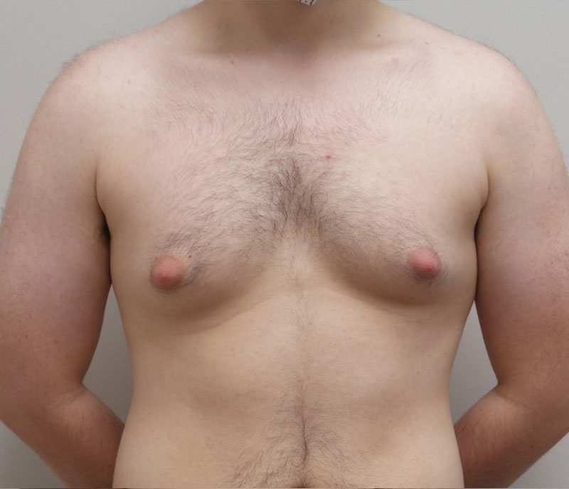 Gynecomastia Before and After Pictures Fort Lauderdale, FL