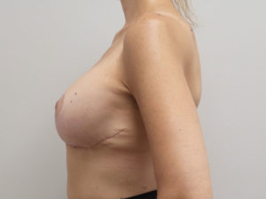 Breast Implant Revision/Replacement Before and After Pictures Fort Lauderdale, FL