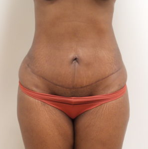 Mini Tummy Tuck Before and After Pictures Fort Lauderdale, FL