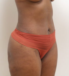 Mini Tummy Tuck Before and After Pictures Fort Lauderdale, FL