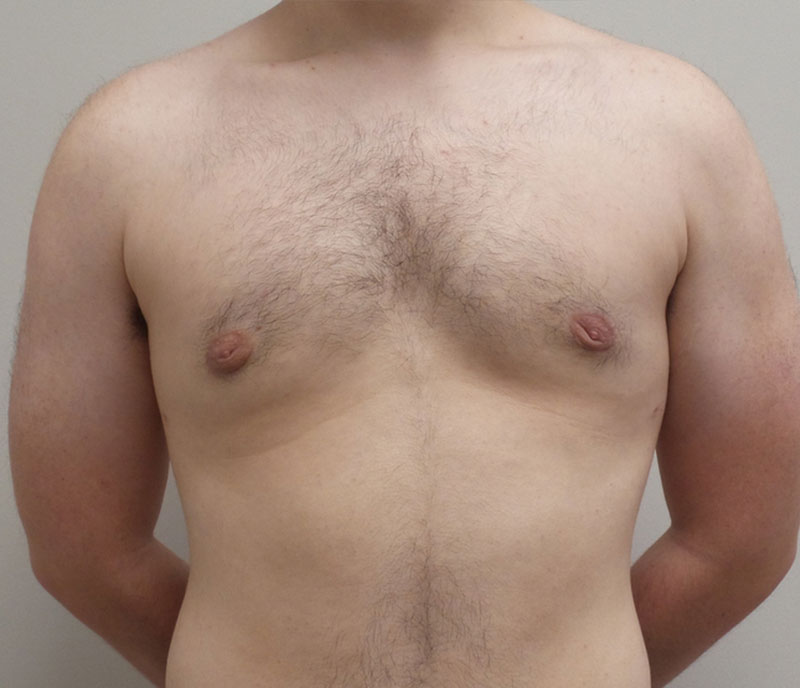 Gynecomastia Before and After Pictures Fort Lauderdale, FL