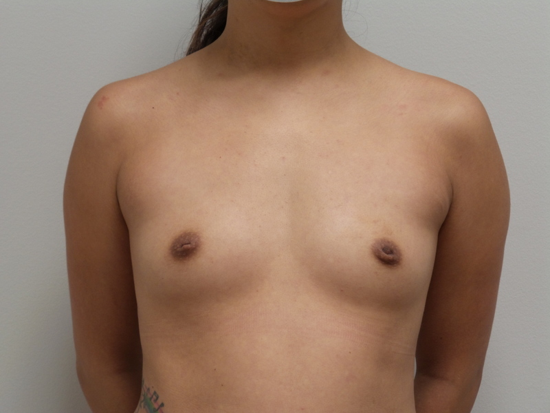 Breast Augmentation Before and After Pictures Fort Lauderdale, FL