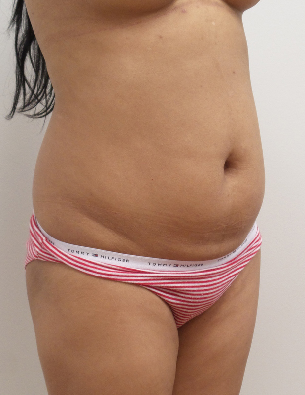 Liposuction with Renuvion Before and After Pictures Fort Lauderdale, FL