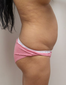Liposuction with Renuvion Before and After Pictures Fort Lauderdale, FL