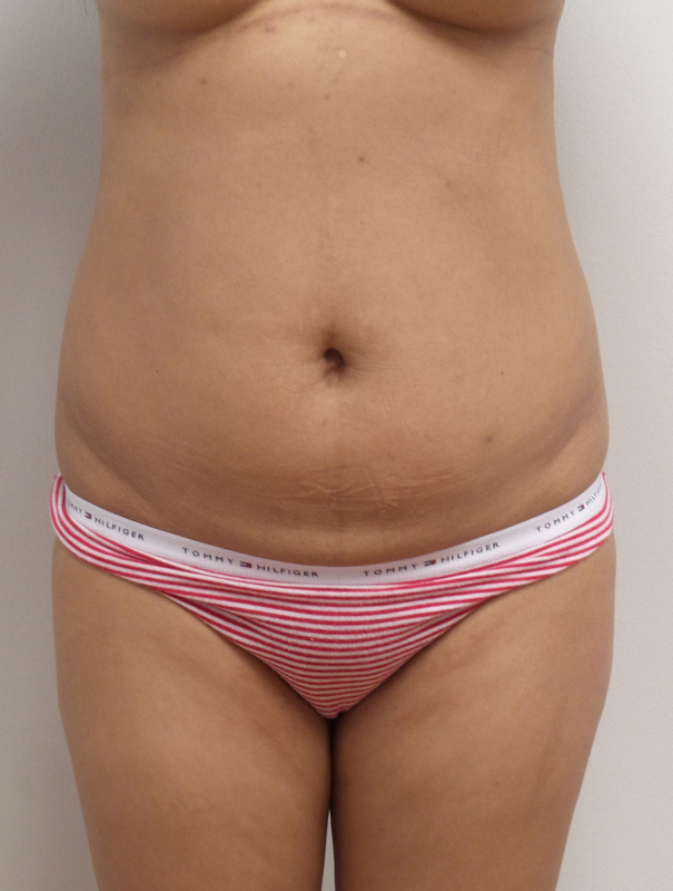 Liposuction with Renuvion Before and After Pictures Fort Lauderdale, FL