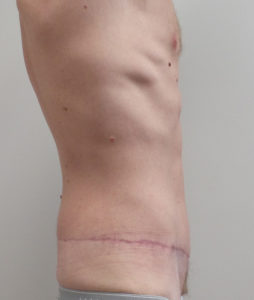 Extended Abdominoplasty Before and After Pictures Fort Lauderdale, FL