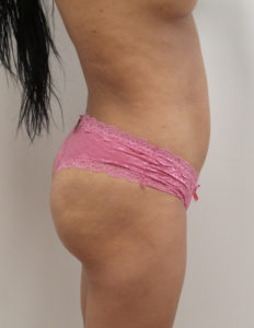 Liposuction with Renuvion Before and After Pictures Fort Lauderdale, FL