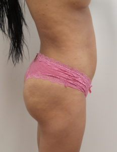 Brazilian Butt Lift Before and After Pictures Fort Lauderdale, FL