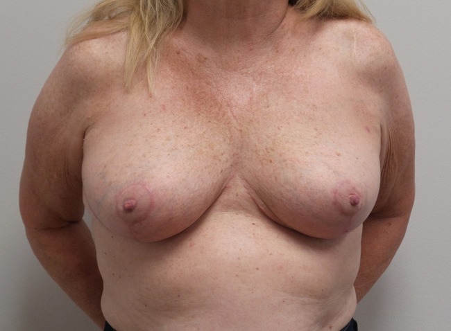 Breast Reduction Before and After Pictures Fort Lauderdale, FL