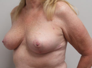 Breast Reduction Before and After Pictures Fort Lauderdale, FL