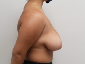 Breast Reduction Before and After Pictures Fort Lauderdale, FL