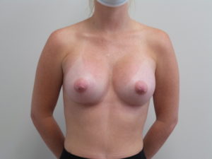 Breast Augmentation Before and After Pictures Fort Lauderdale, FL