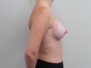 Breast Augmentation Before and After Pictures Fort Lauderdale, FL