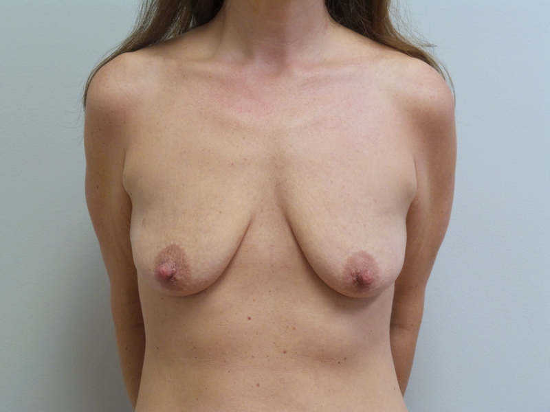 Breast Implant Revision/Replacement Before and After Pictures Fort Lauderdale, FL