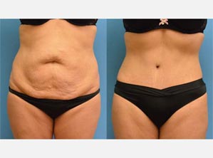Plastic Surgery Before & After Pictures near Fort Lauderdale, FL
