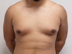 Gynecomastia Before and After Pictures Fort Lauderdale, FL