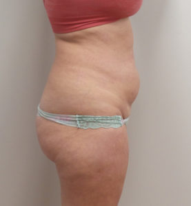 Tummy Tuck Before and After Pictures Fort Lauderdale, FL