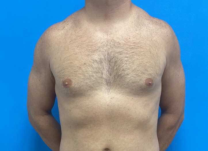 Gynecomastia Before and After Pictures Fort Lauderdale, FL