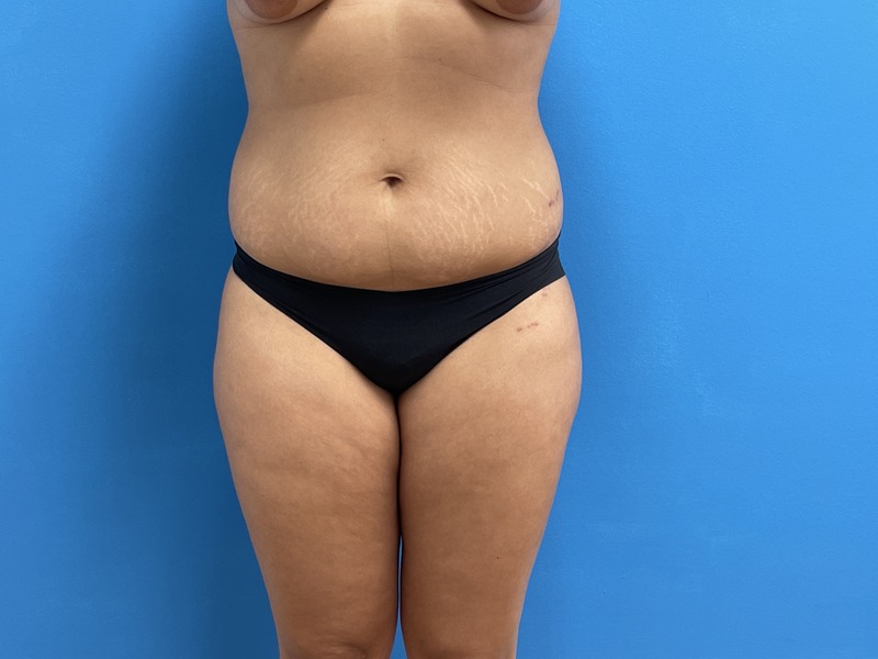 Tummy Tuck Before and After Pictures Fort Lauderdale, FL