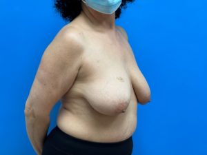 Breast Reduction Before & After Pictures near Fort Lauderdale, FL