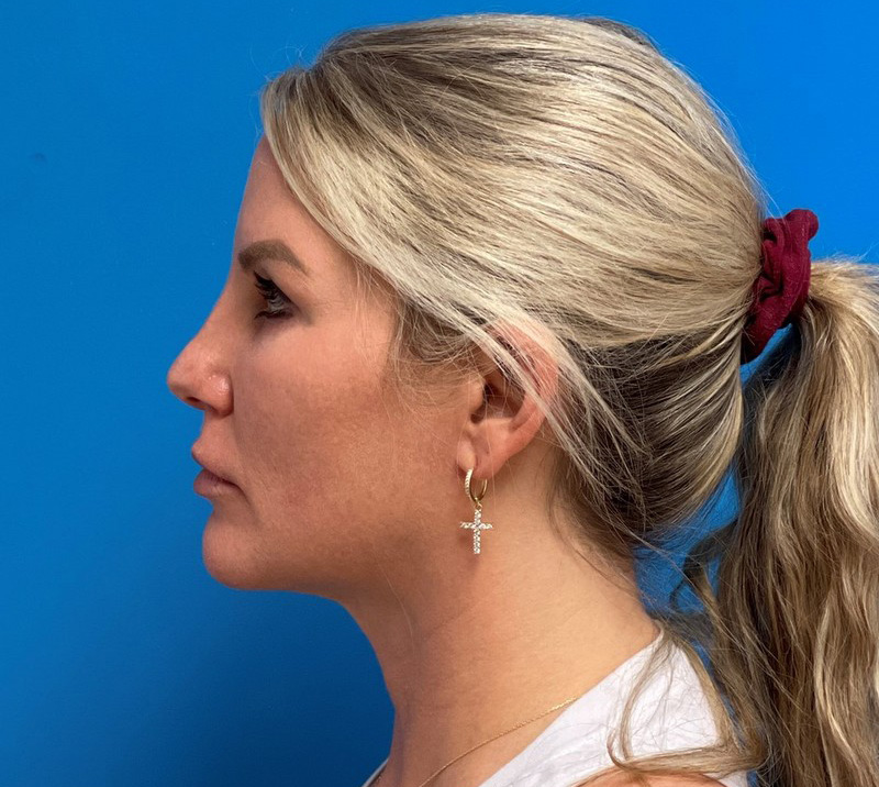 05_03_2021 19_36_00 Neck Liposuction with Renuvion Before & After Pictures near Fort Lauderdale, FL