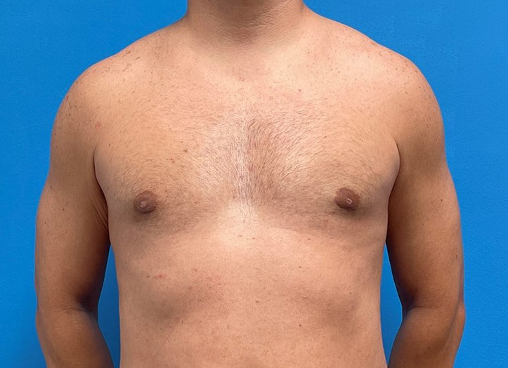 Gynecomastia Before and After Pictures Fort Lauderdale, FL