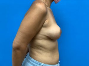 Breast Lift Before and After Pictures Fort Lauderdale, FL