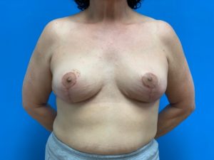 Breast Reduction Before & After Pictures near Fort Lauderdale, FL