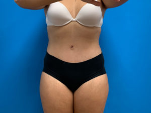 Tummy Tuck Before and After Pictures Fort Lauderdale, FL