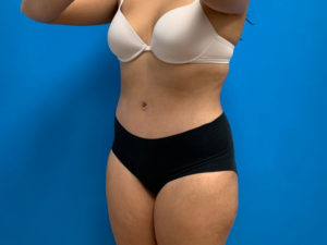 Tummy Tuck Before and After Pictures Fort Lauderdale, FL