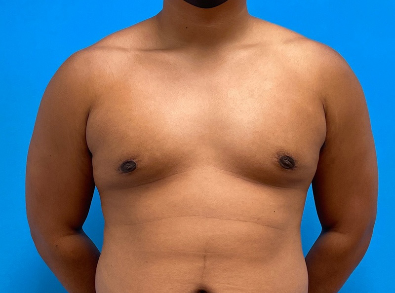 Gynecomastia Before and After Pictures Fort Lauderdale, FL