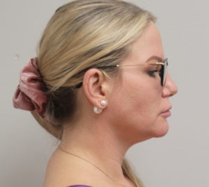 Neck Liposuction with Renuvion Before & After Pictures near Fort Lauderdale, FL