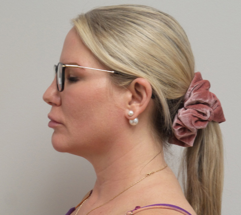 11_13_2020 20_17_00 (1) Neck Liposuction with Renuvion Before & After Pictures near Fort Lauderdale, FL