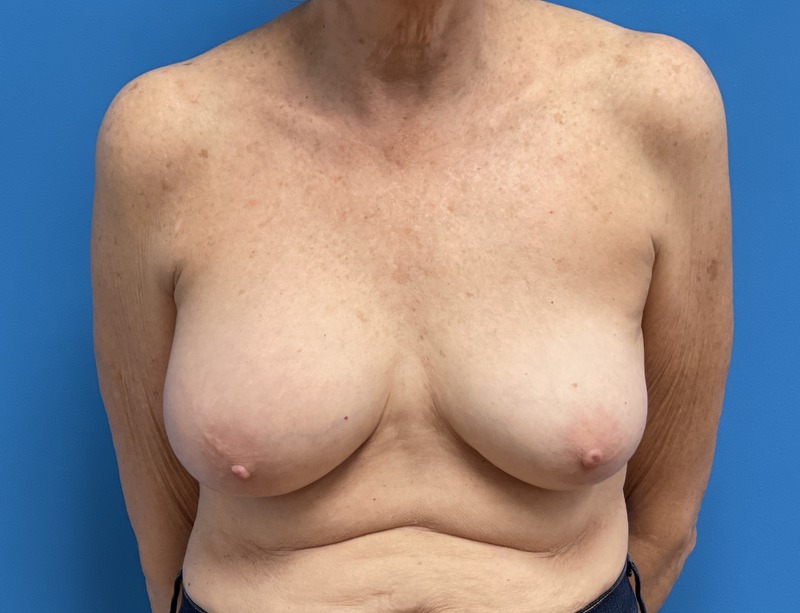 Breast Implant Removal Before & After Pictures near Fort Lauderdale, FL