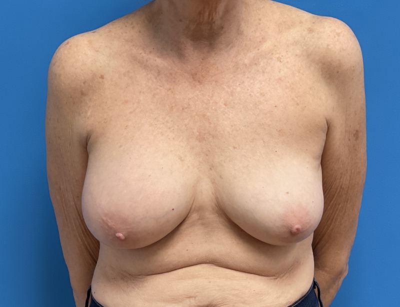06_08_2021 18_45_00 Breast Implant Removal Before & After Pictures near Fort Lauderdale, FL