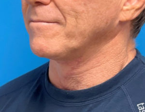 Direct Neck Lift Before & After Pictures near Fort Lauderdale, FL