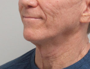 Direct Neck Lift Before & After Pictures near Fort Lauderdale, FL