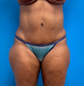 Tummy Tuck Before and After Pictures Fort Lauderdale, FL