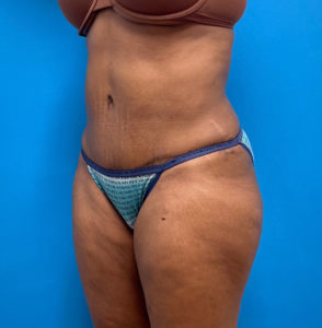 Tummy Tuck Before and After Pictures Fort Lauderdale, FL